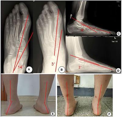 Treatment for Flexible Flatfoot in Children With Subtalar Arthroereisis and Soft Tissue Procedures